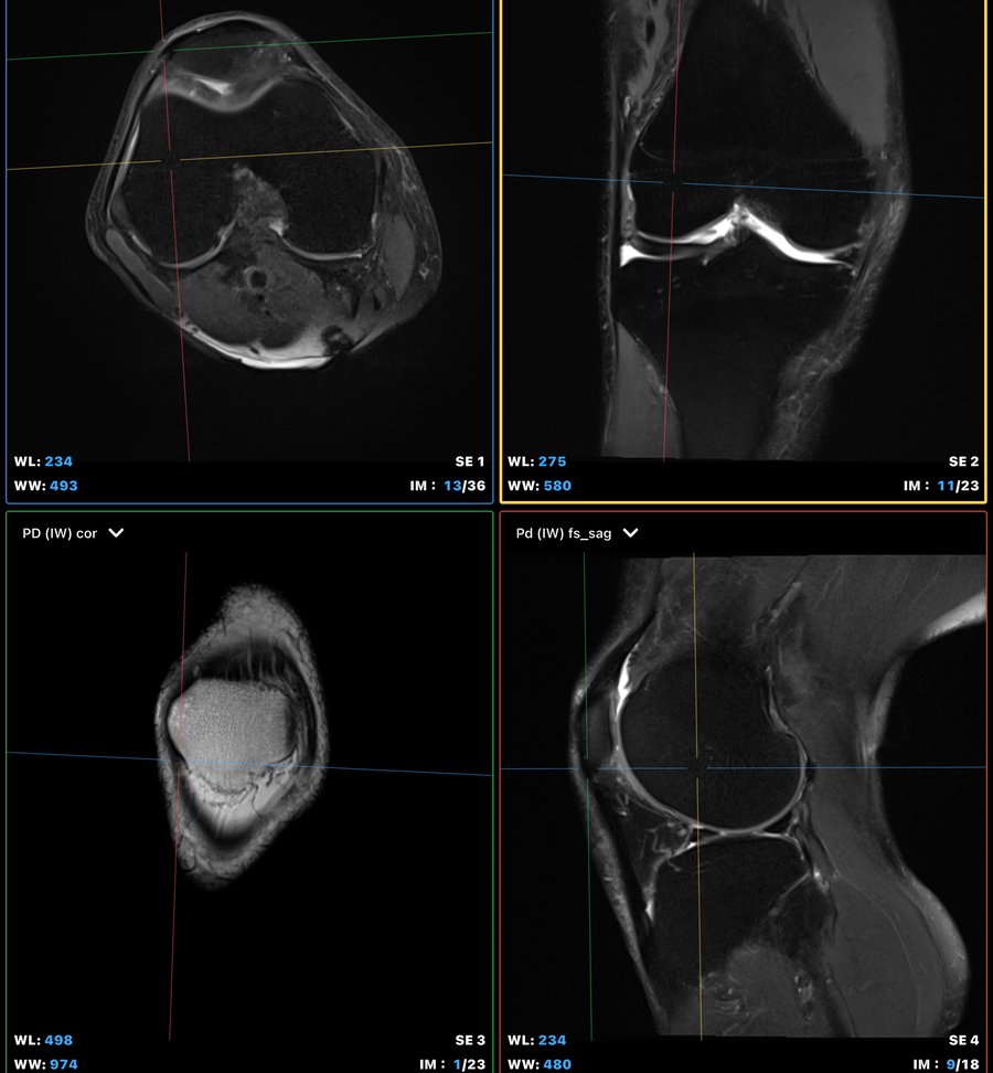 Sample 4-panel 3T knee MRI imaging